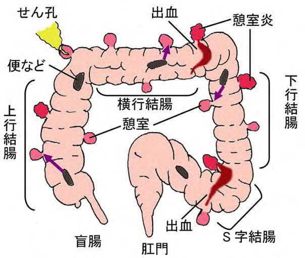 大腸憩室と腸活